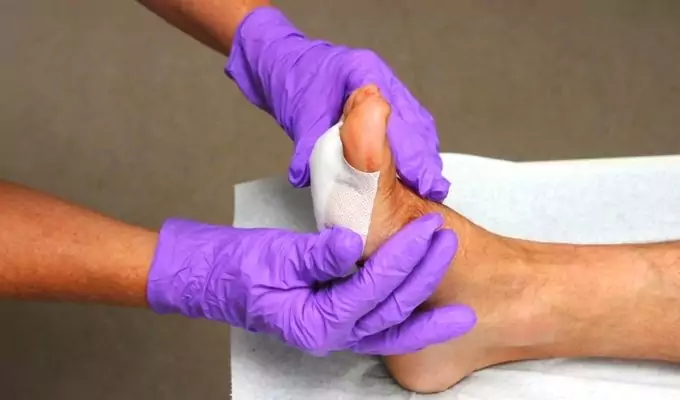 A blister being bandaged