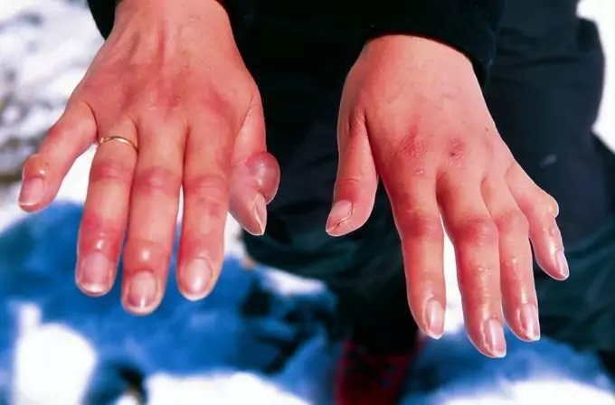 A pair of frostbitten hands