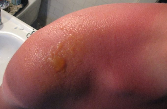 3rd degree burn blister