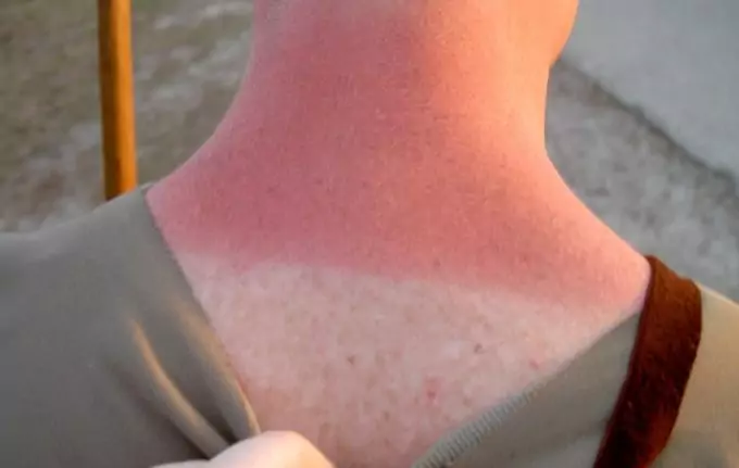 sunburned neck
