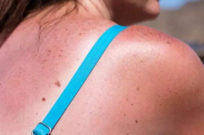 sunburned woman on the sun