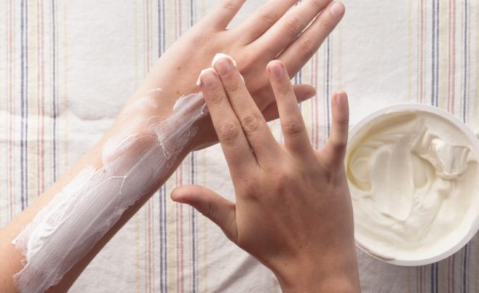 yoghurt for sunburn